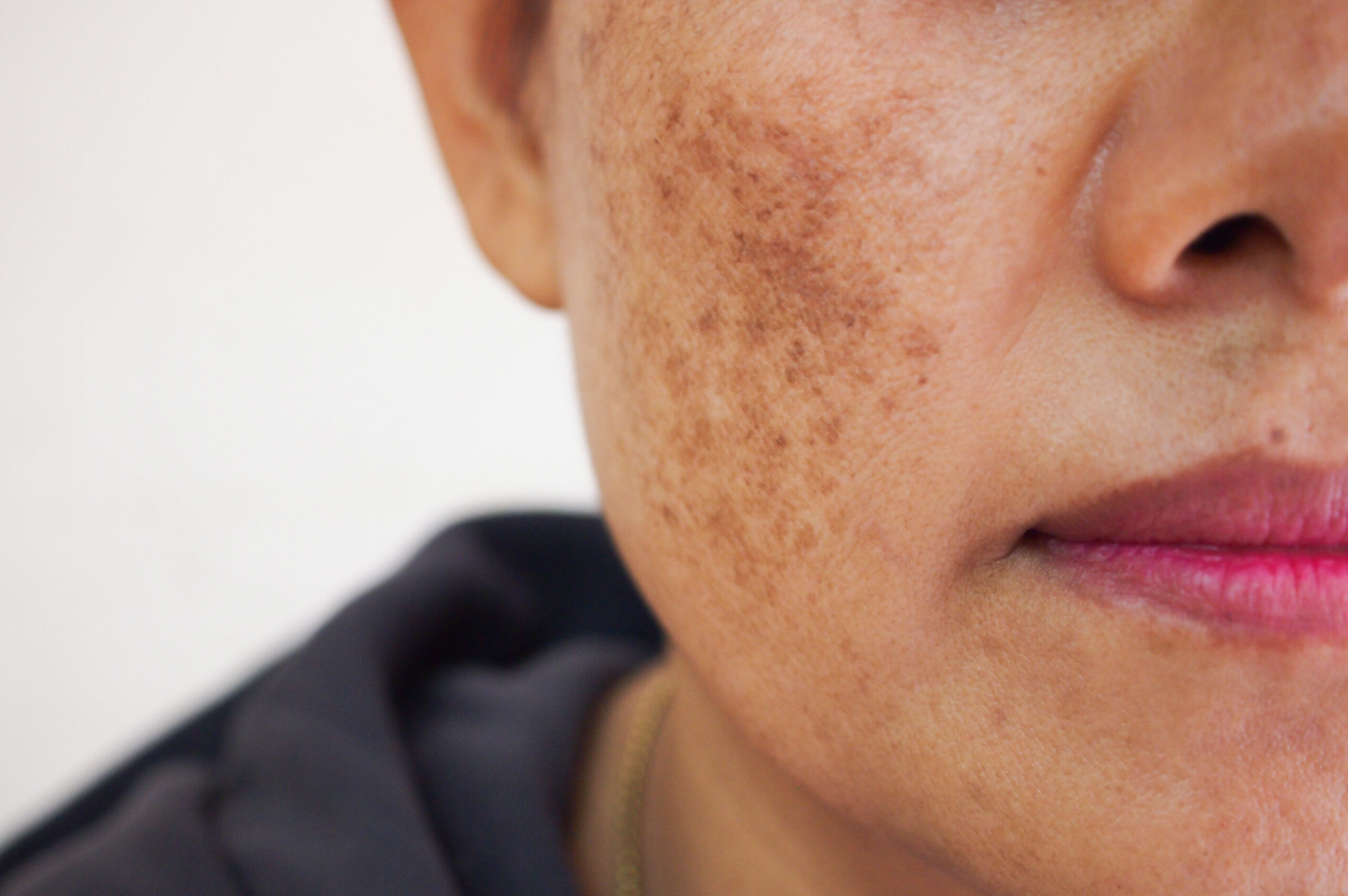 Problem skincare and health concept.Wrinkles,melasma,Dark spots, About Flexile Classic