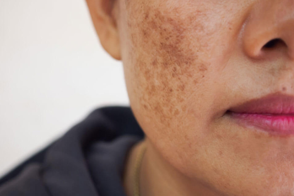 Melasma Treatment