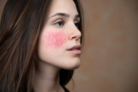 Acne vs. Rosacea. How to Combat Both