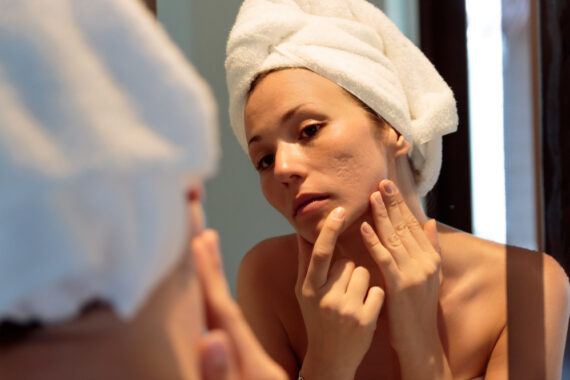 Chemical Peels: Can Chemical Peels Make Acne Scars Worse?