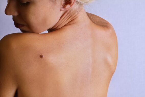 Celebrate Skin Cancer Awareness Month by Getting a Mole Evaluation