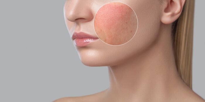 How to Protect My Skin with Rosacea in the Summer