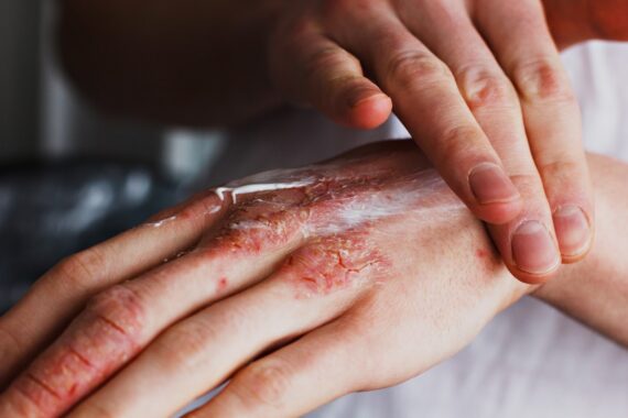 Is There Really a Long-Term Cure for Eczema?
