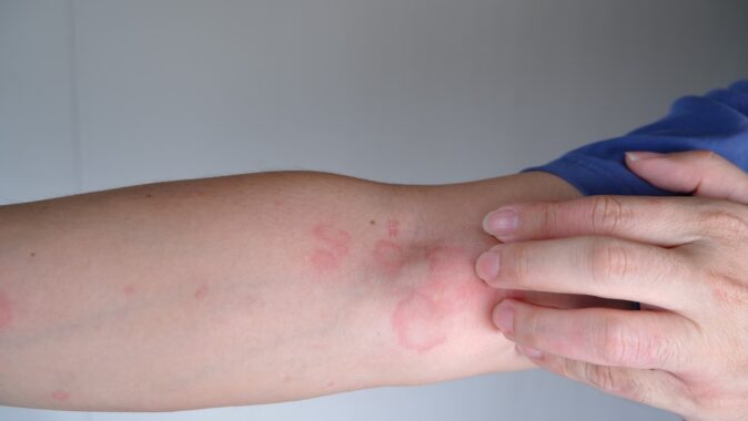 What Are Some Dermatological Cures for Hives?