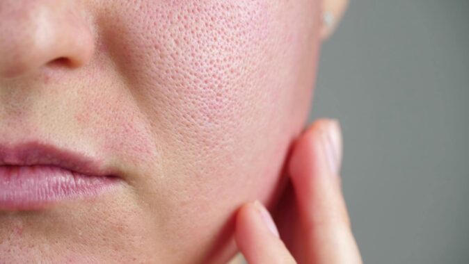 What to Do About Enlarged Pores