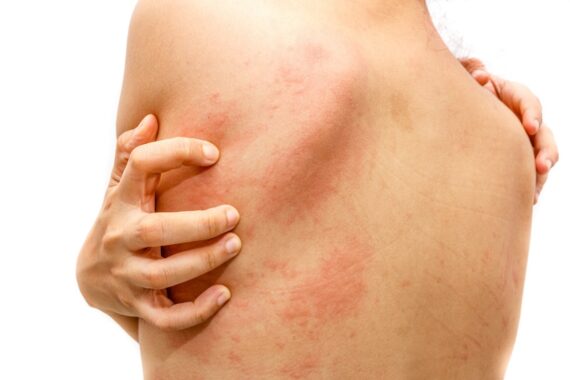Can Hives Be a Sign of Something Serious?