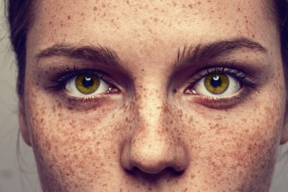 Can You Really Get Rid of Freckles?