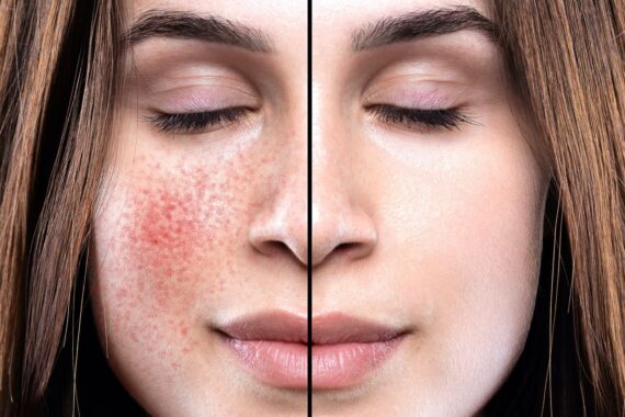 5 Best Ways to Manage Your Rosacea in the Cooler Months