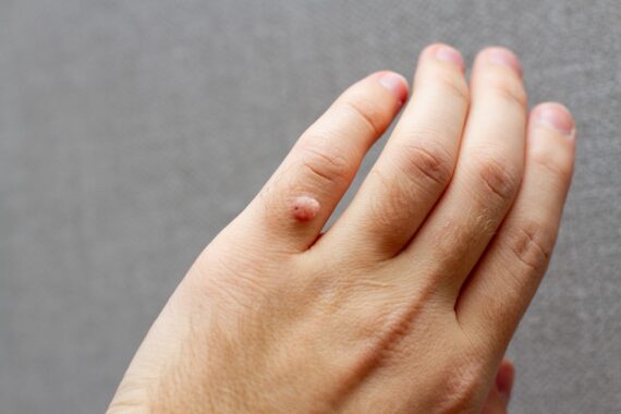How to Detect a Wart and What to Do About Them
