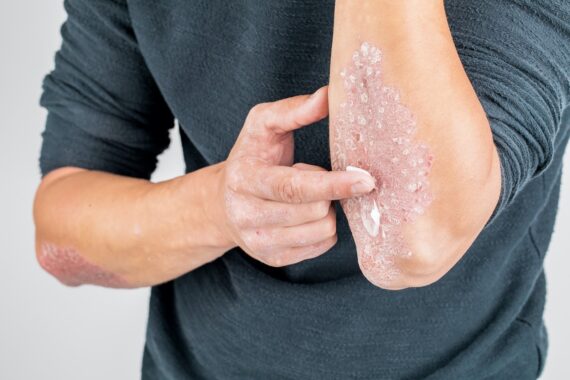 How to Handle Psoriasis This Winter