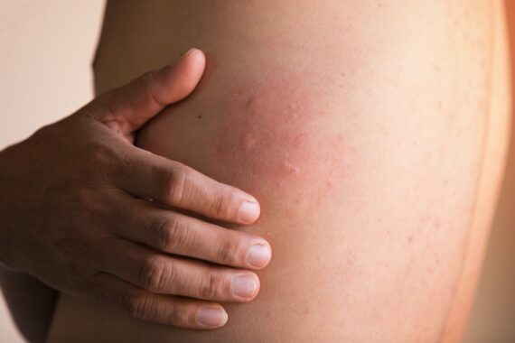 How to Treat and Prevent Hives