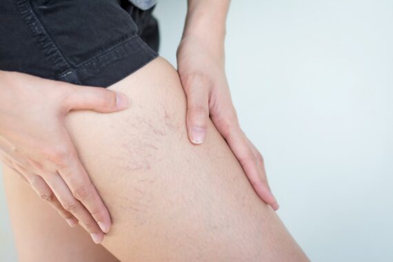 How to Treat Spider Veins Before Swimsuit Season