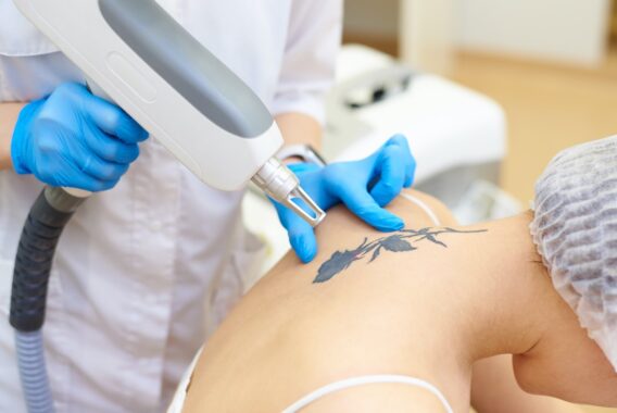 Laser Therapy: From Stretch Marks to Tattoo Removal