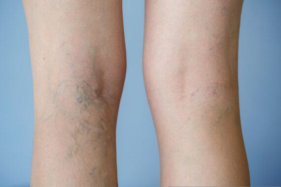 What You Can Do About Leg Veins
