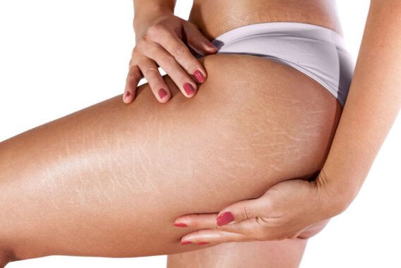 6 Ways to Treat Stretch Marks