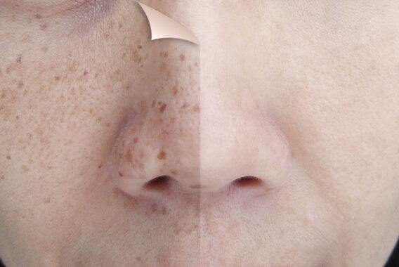 Can You Minimize Freckles?