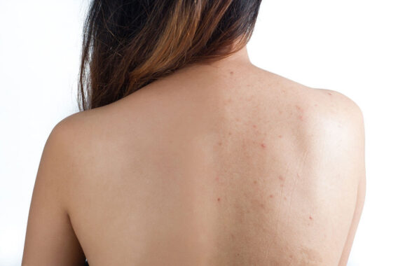 Get Rid of Unsightly Body Acne Today