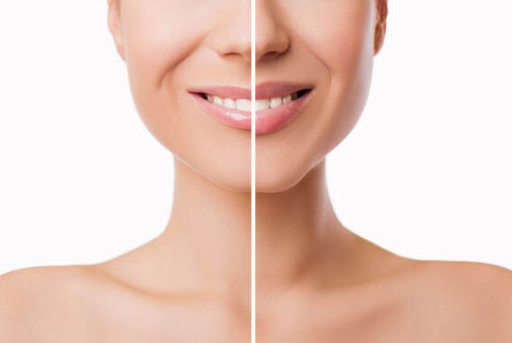 How to Remedy Thinning Lips