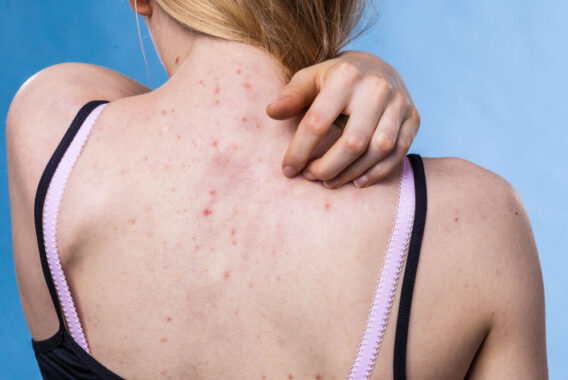 Is Your Acne Really Pityrosporum Folliculitis?