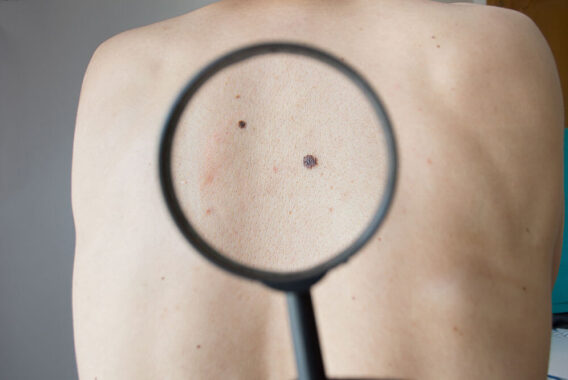 Skin Cancer Awareness Month: 3 Things to Watch Out for When You’re Looking for Skin Cancer