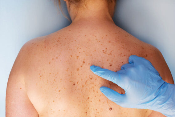 Skin Cancer Awareness Month: Can You Tell If a Spot is Cancerous?