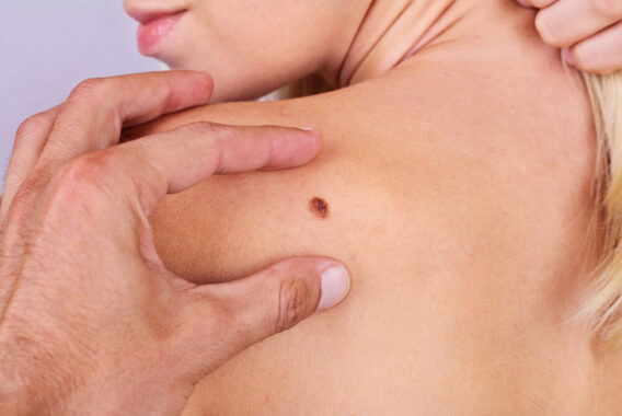 Skin Cancer Awareness Month: Identifying the Early Stages of Skin Cancer