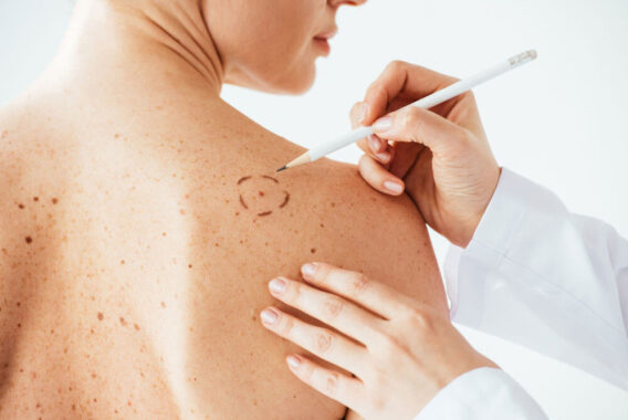 Skin Cancer Awareness Month: Why You Should Never Leave Skin Cancer Untreated