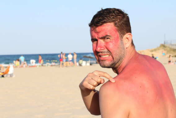 Sunburnt? Here’s What to Do Now
