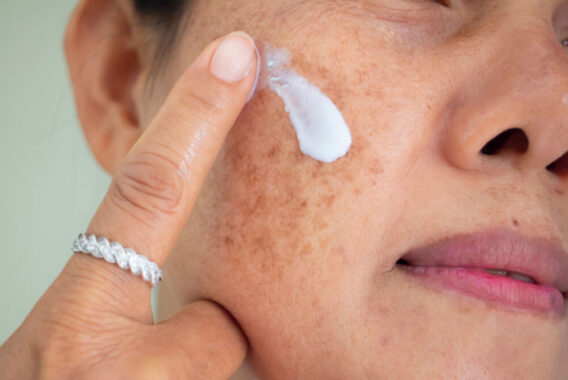 Top Treatment Options for Melasma and Brown Spots