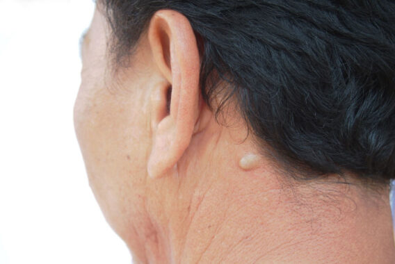 What Are Sebaceous Cysts and How to Treat Them