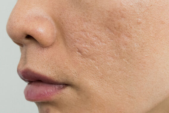 Why You Get Acne Scars and How to Prevent Them