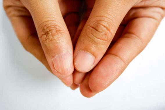 5 Nail Abnormalities Your Dermatologist Can Treat