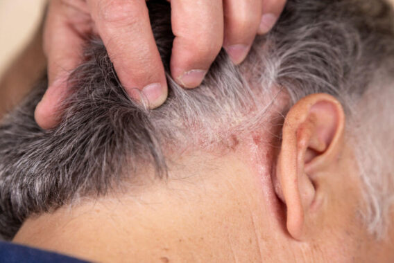 Do I Need to See a Dermatologist About Scalp Psoriasis?