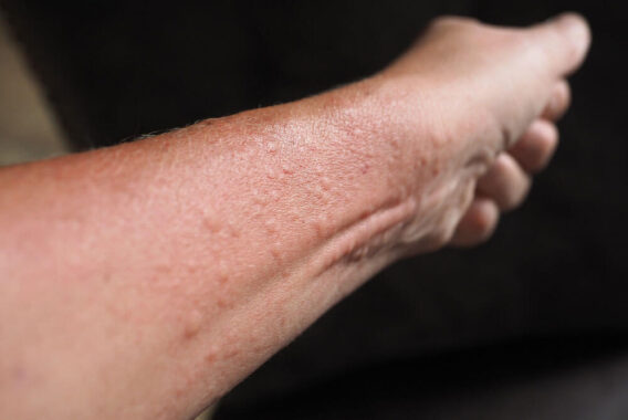 Effective Treatments for Relieving Contact Dermatitis