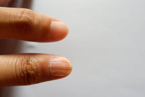How to Treat Nails with Abnormal Shape and Texture