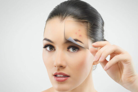 Is There a Cure for Adult Acne?