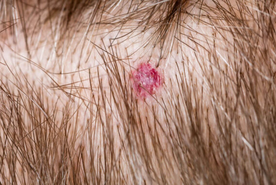 Mohs Surgery to Remove Scalp Lesions: What to Expect