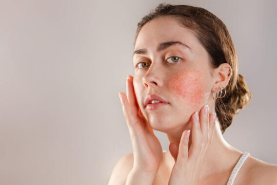 Not Sure if Your Rash is Rosacea? Your Dermatologist Can Help