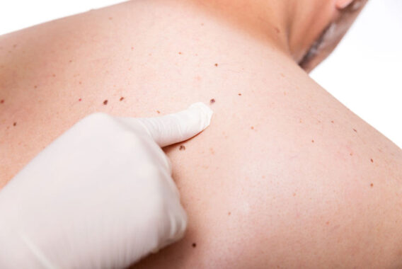 Skin Cancer Screening: Catch Skin Cancer Earlier