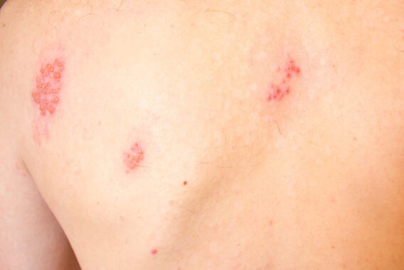 Will I Still Get Herpes Zoster (Shingles) if I Had Chicken Pox?