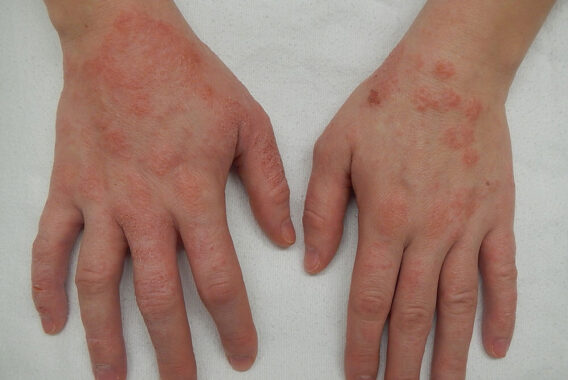 What are the Common Causes of Eczema?