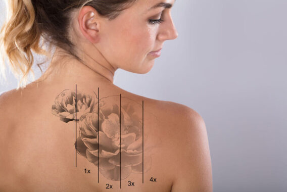 Dermatologist Approved Laser Tattoo Removal Is an Option