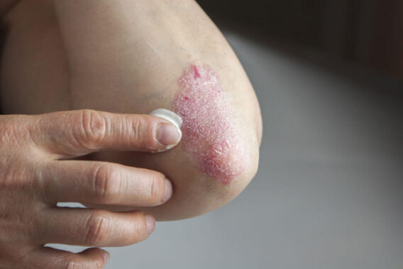 The 10 Best Treatments for Your Psoriasis