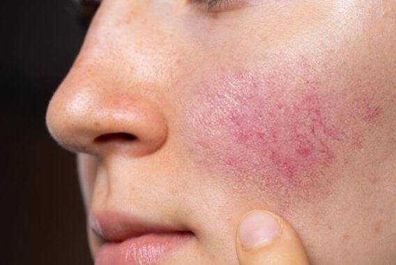 What Are the Common Causes and Symptoms of Rosacea?
