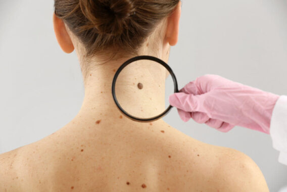 Deadly Moles: Knowing When to See a Doctor