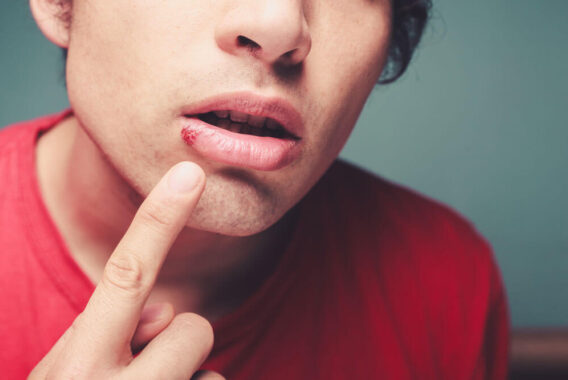 How You Can Treat Cold Sores and Other Herpes Symptoms