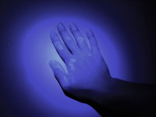 Light Therapy: Exploring a Surprising Vitiligo Treatment