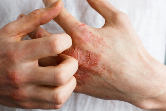 Preventing Infection, Cracking, and Discomfort in Your Eczema