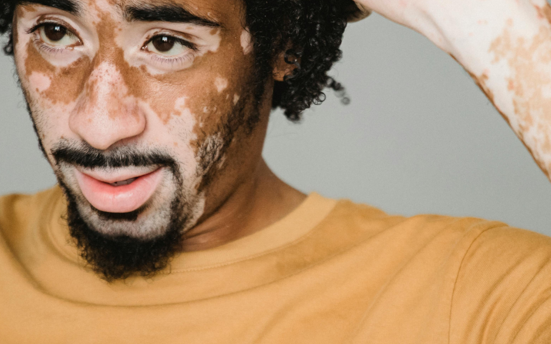 How Dermatologists Help Manage Autoimmune Skin Conditions